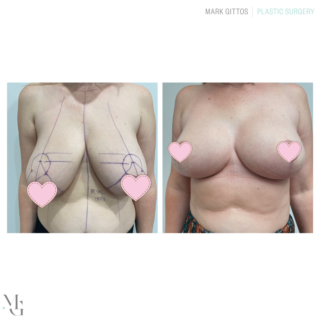 Breast Reduction Before and After Photos - Dr Mark Gittos NZ